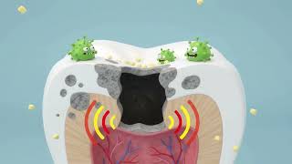 How Tooth Decay Forms in Children & How to Prevent Cavities (3D Cutaway)