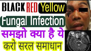 #coronavirus और अब ये गर्मी सूजन चमड़ी पर काले लाल पीले infection, reason and simple solution