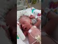 IUGR/SGA baby in NICU