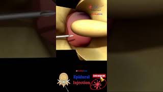 Epidural Injection - Epidural Anesthesia