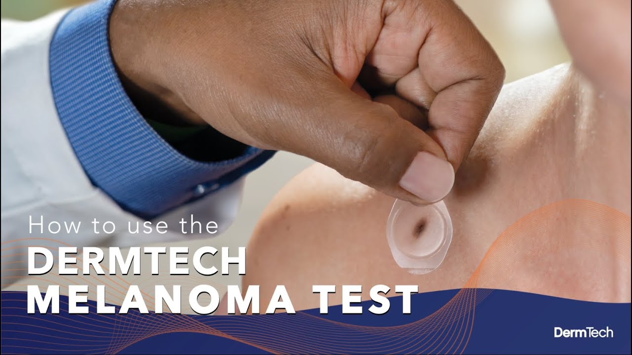 How To Use The DermTech Melanoma Test