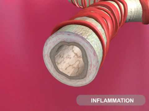 Understanding Asthma - 360p [Animation]