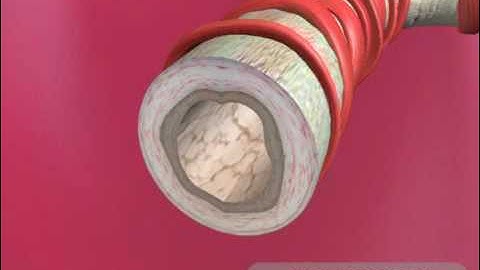 Understanding Asthma - 360p [Animation]