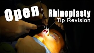Open Rhinoplasty For Tip Revision