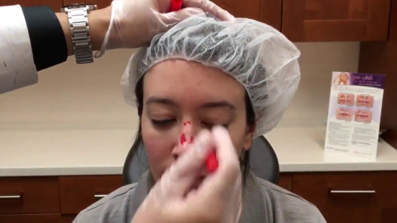 Liquid Nose Job, by Dr. Valaie, MD Newport Beach, Orange