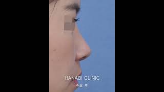 [하나비] 화살코성형 [전후사례] #하나비성형외과 #화살코성형