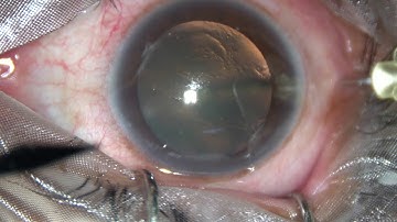 INTRAVITREAL  INJECTION  OF ANTI-VEGF - Pradip Mohanta, VR Fellow of SN, Chennai