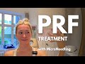 PRF Face Treatment + Microneedling: Full Process &amp; 48-Hour Results | Vita Nova Skincare