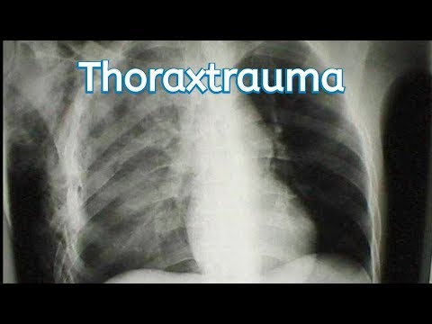 Video: Lungenentzündung Bei Schwerverletzten Patienten Mit Thoraxtrauma: Ergebnisse Einer Retrospektiven Multizentrischen Beobachtungsstudie