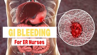 GI Bleeds Explained for New ER Nurses / Treatments and Nursing Tips / Gastrointestinal Bleeding screenshot 5
