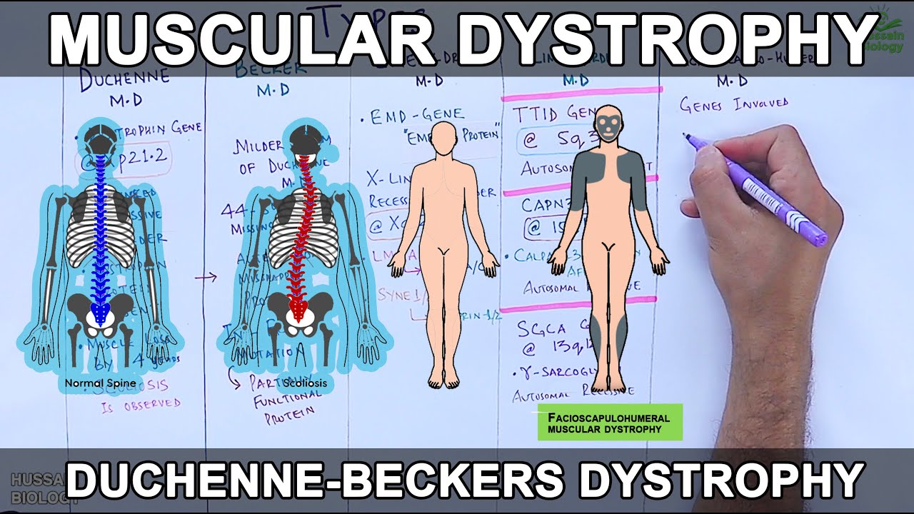 Muscular Dystrophy Types And Mutations YouTube Muscular Dystrophy Types And Mutations YouTube