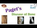 Pagets disease of bone osteitis deformans  causes pathogenesis symptoms diagnosis  treatment