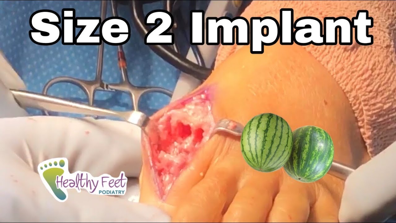 Big Toe Joint Implant!!! Big Toe Joint Arthritis Cure, Hallux Limitus