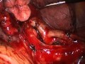 Pulmonary arterial dissection during lingular segmentectomy