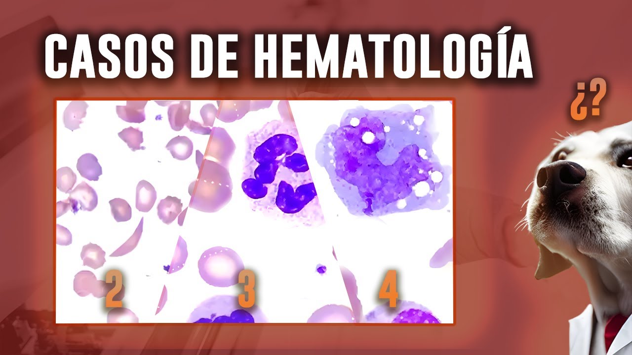 DESAFÍA tu CONOCIMIENTO CON ESTOS CASOS CLÍNICOS hematológicos (2, 3 y 4)