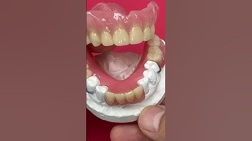 Upper Denture and Lower Partial