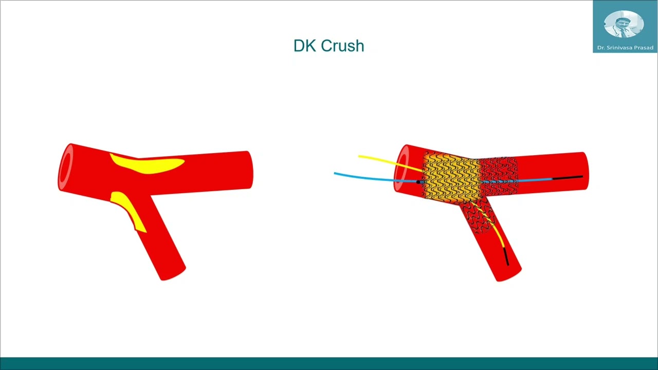 Coronary Bifurcation PCI techniques step by step - animated