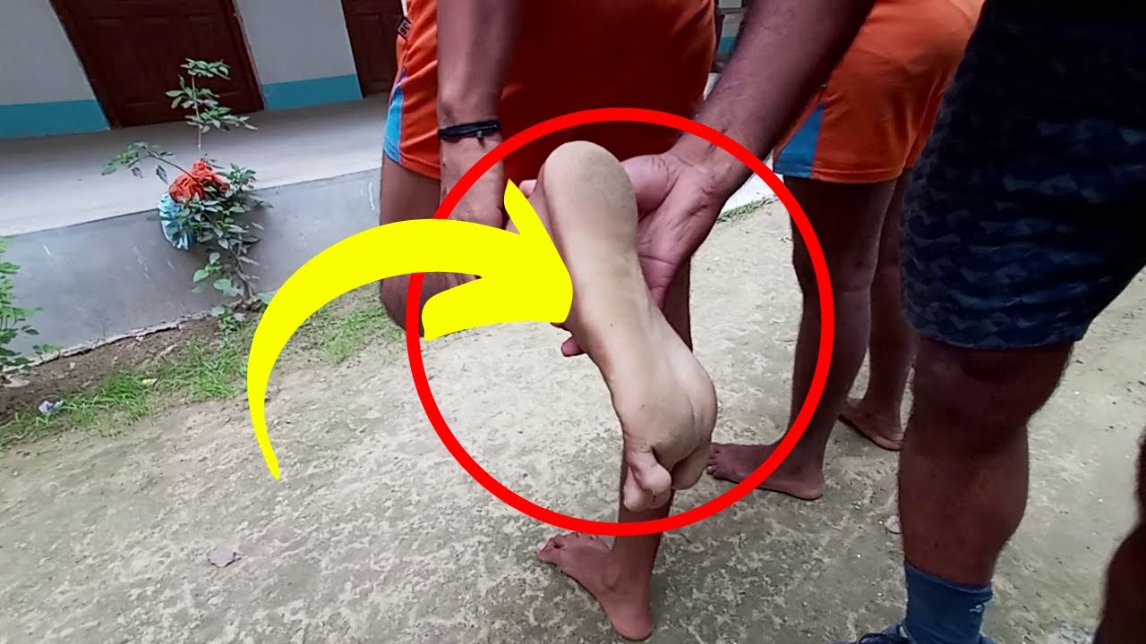 What is Flat Foot How to check Flat Foot Flat Foot कैसे चेक करें घर