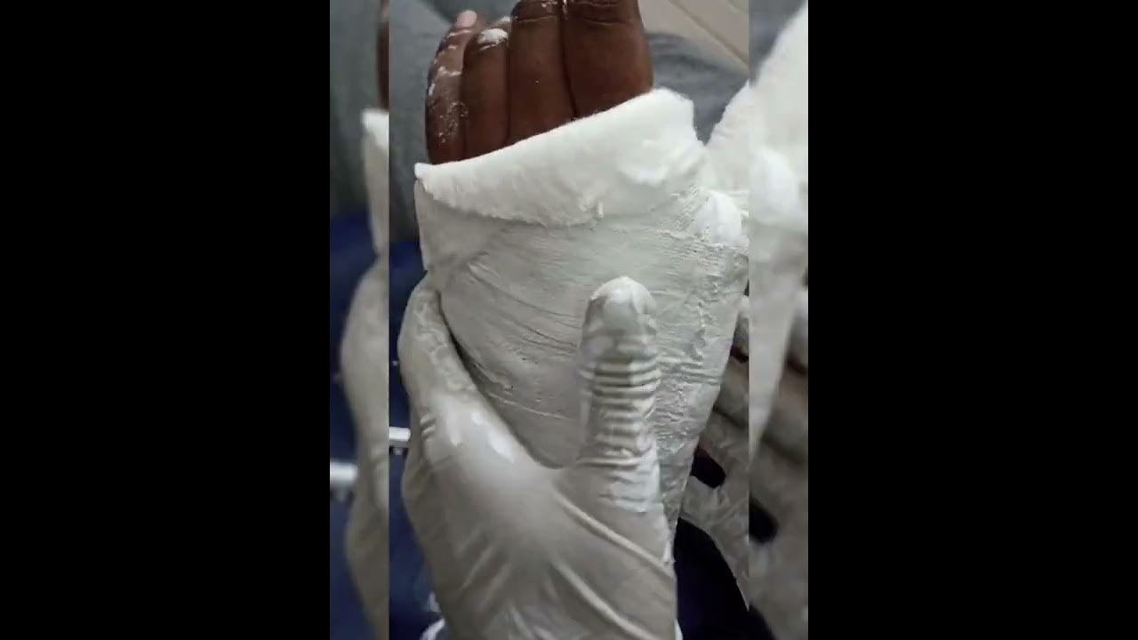 scaphoid bone fracture. aplay scaphoid cast கை எழும்பு முறிவு மாவு கட்டு YouTube