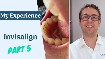 My Invisalign Experience Part 5 - I’m done, kind of!