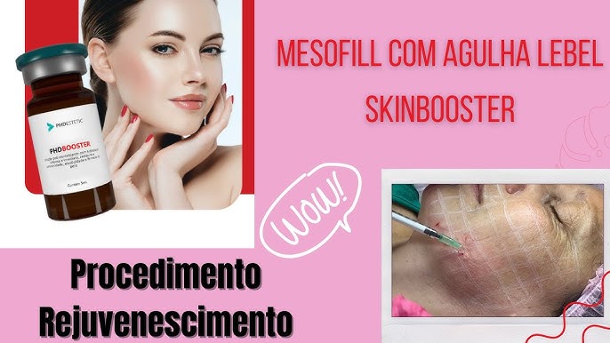 Lipo Enzimática Facial e Papada - Emagrecimento facial 