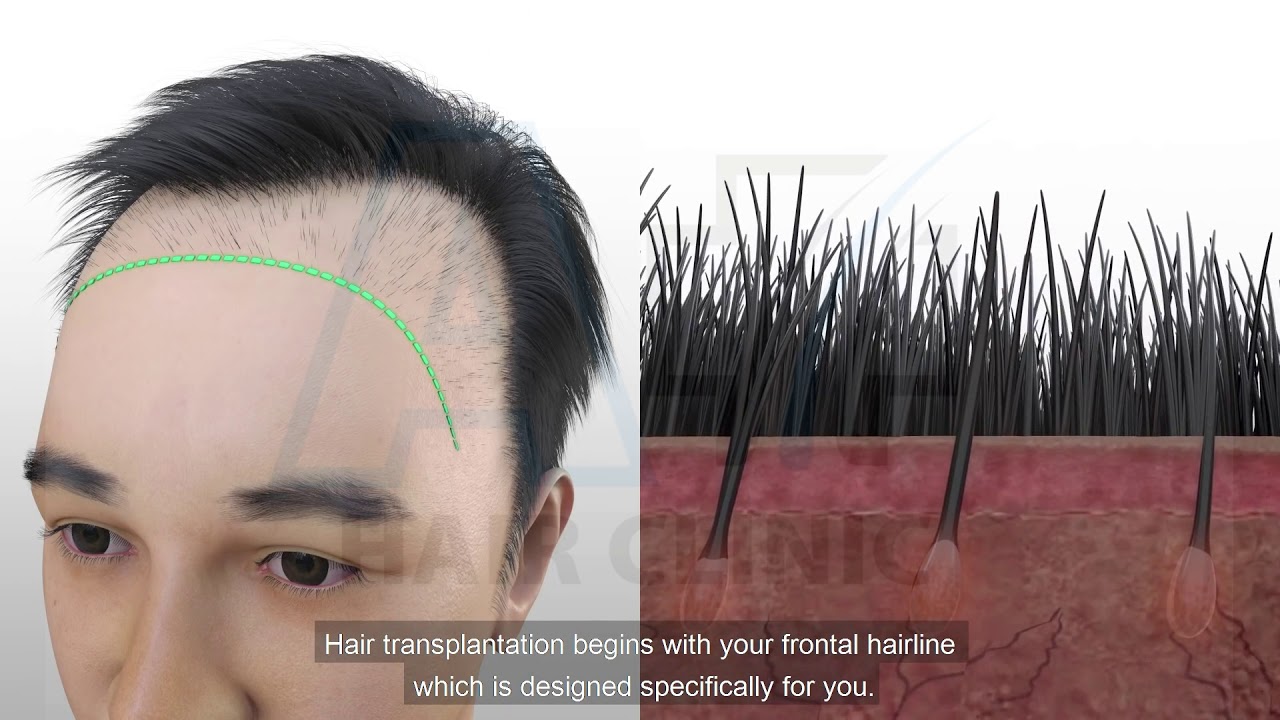 DHI (DIRECT HAIR IMPLANTATION) HAIR TRANSPLANT - YouTube