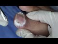 Ep_2601 Ingrown toenail removal 👣 ผมขอเก็บให้แฟนดูครับ 😷 (This clip is from Thailand)