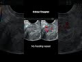 Submucosal Fibroid or Endometrial Polyp? | TVS | 3D Ultrasound Case