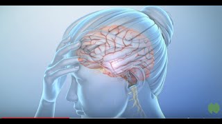 What Is a Migraine Headache?