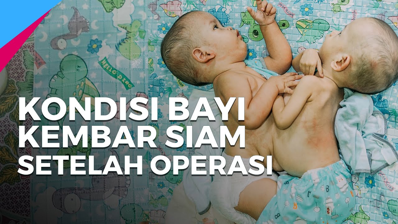 Perjuangan Bayi Kembar Siam Di Tangerang Sampai Berhasil Dipisahkan
