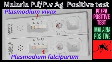 Malaria positive | Pv and Pf antigen Positive test | @medicallabtechnologysajal6903