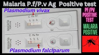 Malaria positive | Pv and Pf antigen Positive test | @medicallabtechnologysajal6903 screenshot 4