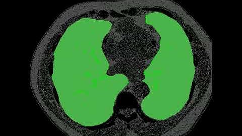 Lung Segmentation from CT images using S-GAN