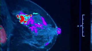MRI for Breast Cancer-Mayo Clinic