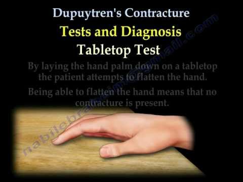 Dupuytren&rsquo;s Contracture - Everything You Need To Know - Dr. Nabil Ebraheim