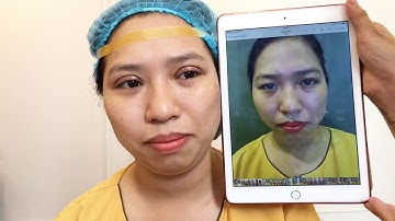 Cắt Mí Mani Open Deep 5D Không Sưng Tím Tại Dr.Hải Lê.