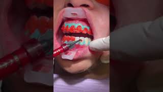 NEW Teeth Whitening Procedure at View Mobile Dental | Arnold Paulos DDS screenshot 4