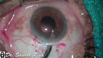 CORTEX REMOVAL IN SMALL PUPIL WITHOUT SIDE PORT BY SIMCOE CANNULA - Dr. Saurav Piya