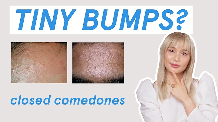 Why those tiny bumps AREN’T fungal acne! - DayDayNews