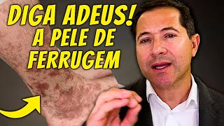 Dermatite Ocre - Como clarear as pernas?