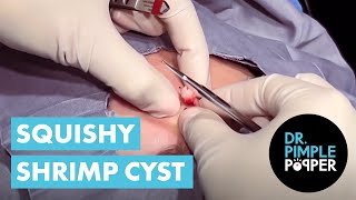 A SQUISHY SHRIMP CYST