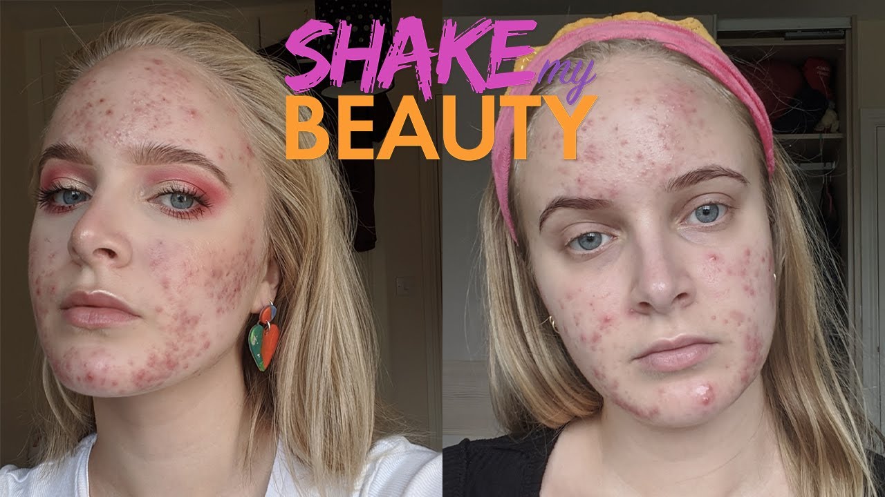My Acne's So Bad My Dermatologist Grimaced | SHAKE MY BEAUTY