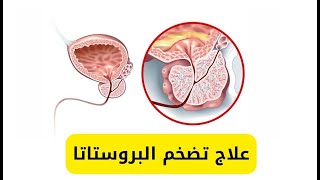 علاج تضخم البروستاتا