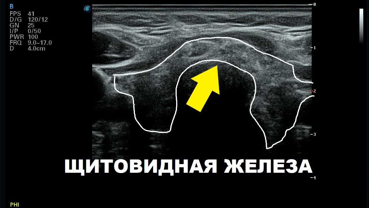Хронический тиреоидит на УЗИ - YouTube