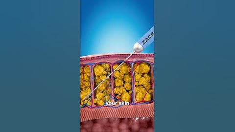 How Liposuction Works 💉🤔