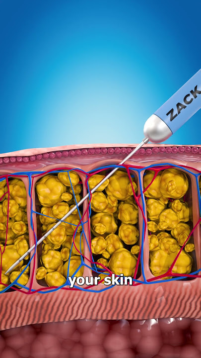 How Liposuction Works 💉🤔