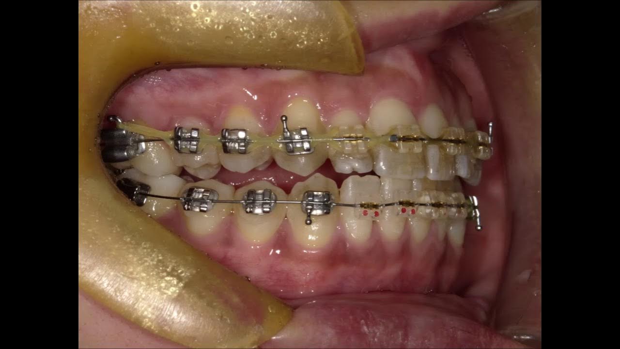 Orthodontic Slide show YouTube