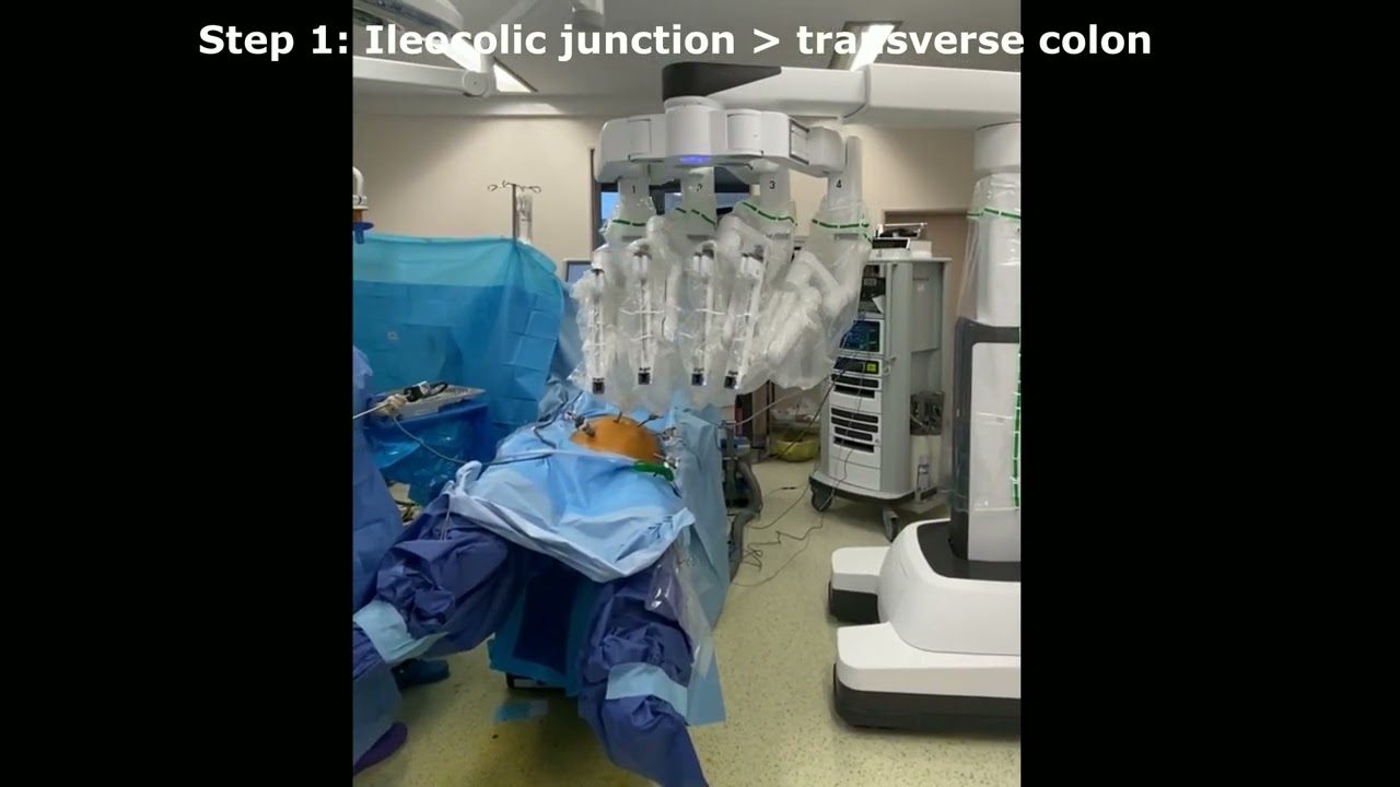 Port placement strategies and management of the robotic system during colo/proctectomy for cancer