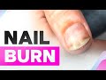 Nail Burn | Onycholysis | Clean Manicure