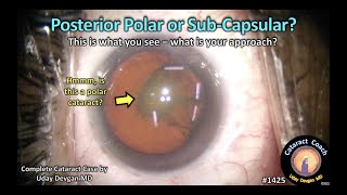 CataractCoach 1425: posterior polar or posterior sub-capsular?